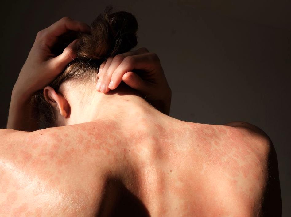 Tips for Managing Skin Care with Psoriasis