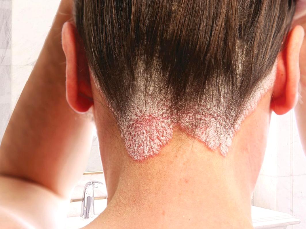 Guidance on Skincare for Those with Psoriasis