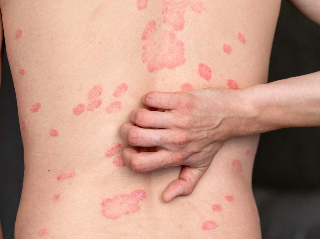 Best Skincare Practices for Psoriasis Sufferers