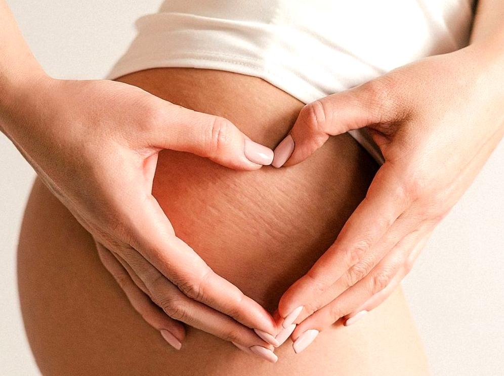 Ways to Manage and Avoid Stretch Marks