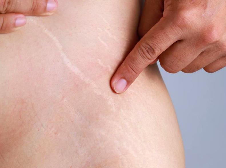 Tips for Preventing and Treating Stretch Marks