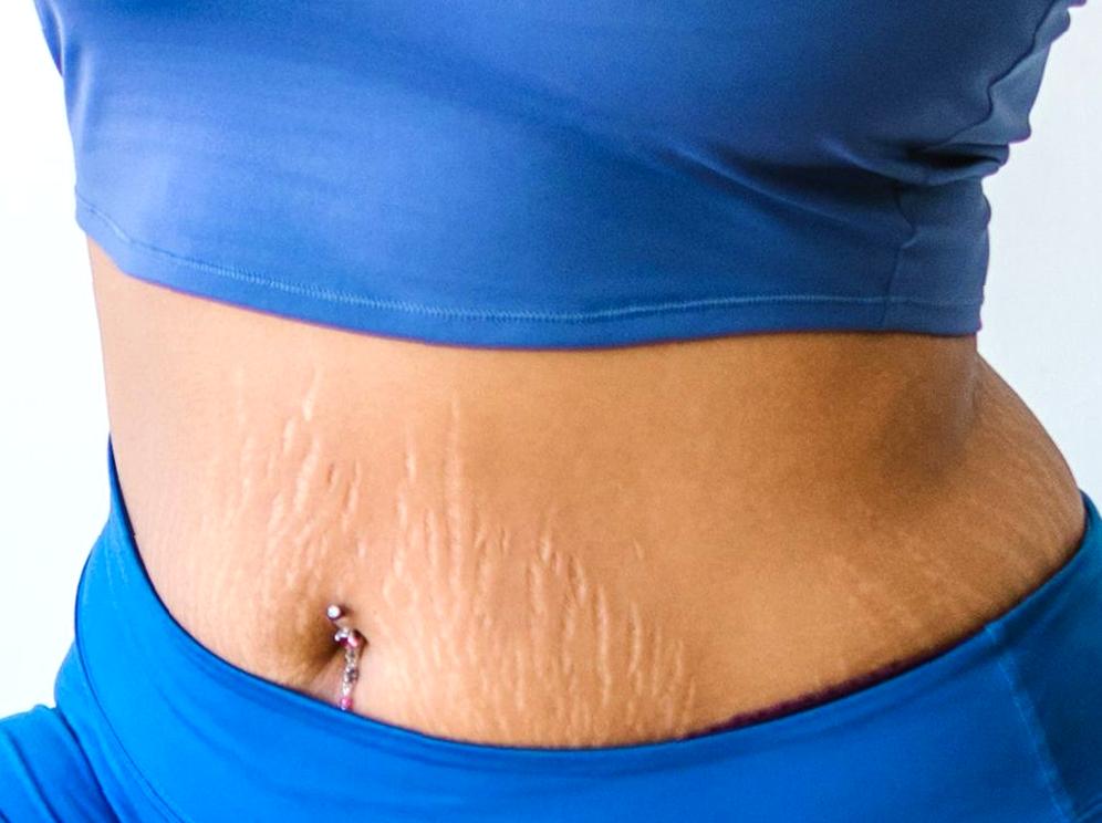 Approaches to Stretch Marks Treatment and Prevention